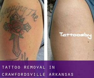 Tattoo Removal in Crawfordsville (Arkansas)
