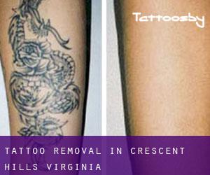 Tattoo Removal in Crescent Hills (Virginia)