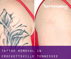 Tattoo Removal in Crockettsville (Tennessee)