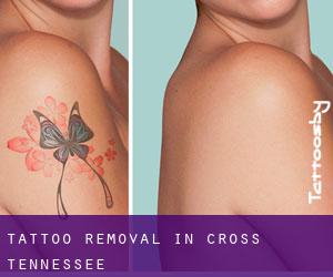 Tattoo Removal in Cross (Tennessee)