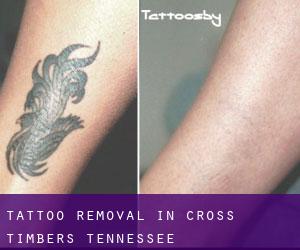 Tattoo Removal in Cross Timbers (Tennessee)