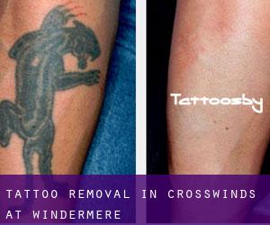 Tattoo Removal in Crosswinds At Windermere