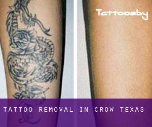 Tattoo Removal in Crow (Texas)