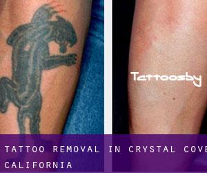 Tattoo Removal in Crystal Cove (California)