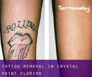 Tattoo Removal in Crystal Point (Florida)