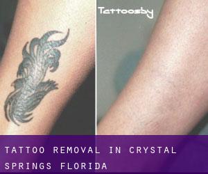 Tattoo Removal in Crystal Springs (Florida)