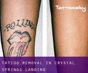 Tattoo Removal in Crystal Springs Landing