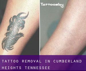 Tattoo Removal in Cumberland Heights (Tennessee)