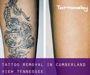 Tattoo Removal in Cumberland View (Tennessee)