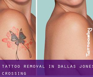 Tattoo Removal in Dallas Jones Crossing