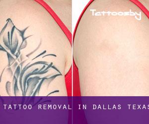 Tattoo Removal in Dallas (Texas)