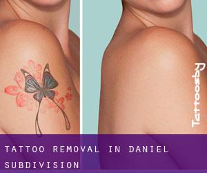 Tattoo Removal in Daniel Subdivision