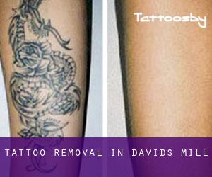 Tattoo Removal in Davids Mill