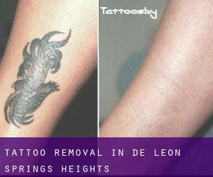 Tattoo Removal in De Leon Springs Heights