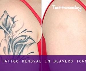 Tattoo Removal in Deavers Town