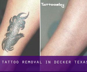 Tattoo Removal in Decker (Texas)