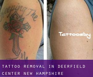 Tattoo Removal in Deerfield Center (New Hampshire)