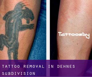 Tattoo Removal in Dehne's Subdivision