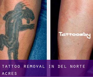 Tattoo Removal in Del Norte Acres