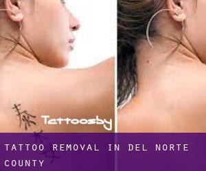 Tattoo Removal in Del Norte County