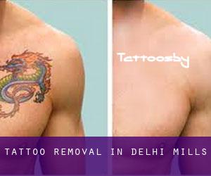 Tattoo Removal in Delhi Mills