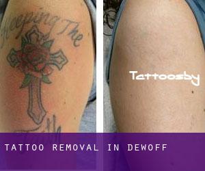 Tattoo Removal in DeWoff