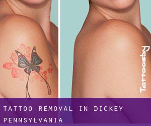 Tattoo Removal in Dickey (Pennsylvania)