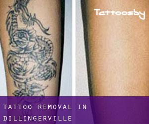 Tattoo Removal in Dillingerville