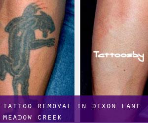 Tattoo Removal in Dixon Lane-Meadow Creek