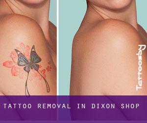 Tattoo Removal in Dixon Shop
