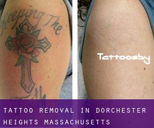 Tattoo Removal in Dorchester Heights (Massachusetts)