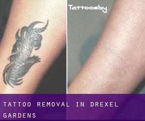 Tattoo Removal in Drexel Gardens
