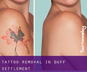 Tattoo Removal in Duff Settlement
