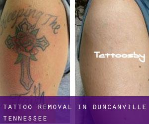 Tattoo Removal in Duncanville (Tennessee)