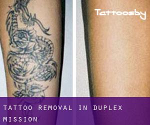 Tattoo Removal in Duplex Mission