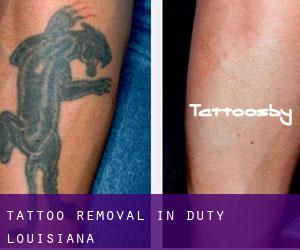 Tattoo Removal in Duty (Louisiana)