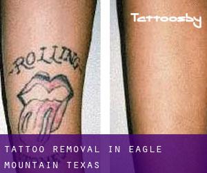 Tattoo Removal in Eagle Mountain (Texas)
