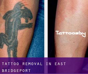 Tattoo Removal in East Bridgeport