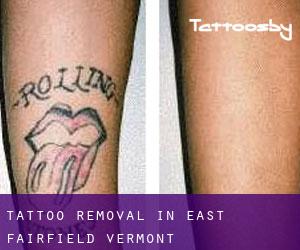 Tattoo Removal in East Fairfield (Vermont)