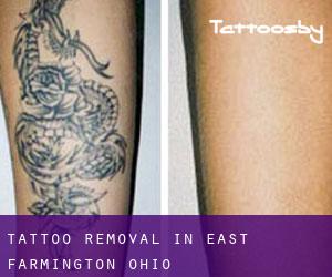 Tattoo Removal in East Farmington (Ohio)