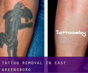 Tattoo Removal in East Greensboro