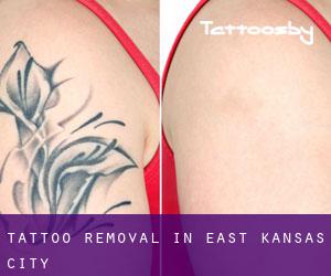 Tattoo Removal in East Kansas City