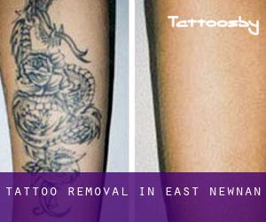 Tattoo Removal in East Newnan