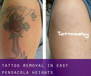 Tattoo Removal in East Pensacola Heights