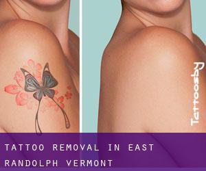 Tattoo Removal in East Randolph (Vermont)