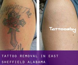 Tattoo Removal in East Sheffield (Alabama)