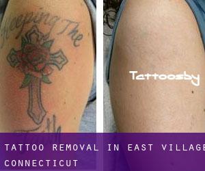 Tattoo Removal in East Village (Connecticut)