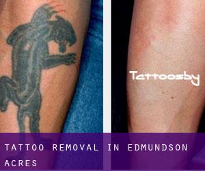 Tattoo Removal in Edmundson Acres