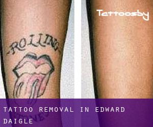 Tattoo Removal in Edward Daigle