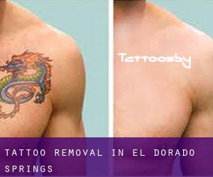 Tattoo Removal in El Dorado Springs